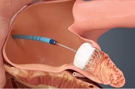 Watchman Implant: Empowering Patients with Atrial Fibrillation post thumbnail image