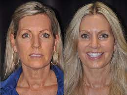 Santa Barbara’s Secret to Ageless Charm: Experience Facelift Excellence post thumbnail image