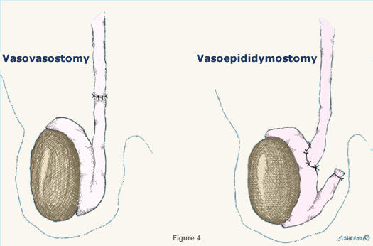 Vasectomy Reversal: Is It Worth the Investment? post thumbnail image