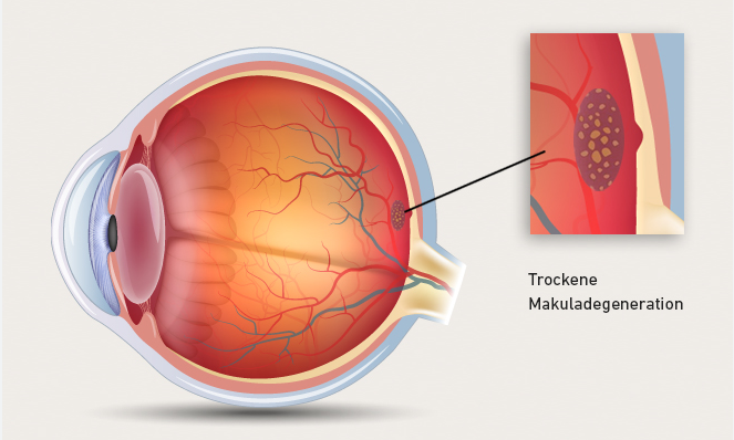 Macular Degeneration Unveiled: A Closer Look at the Eye’s Center post thumbnail image